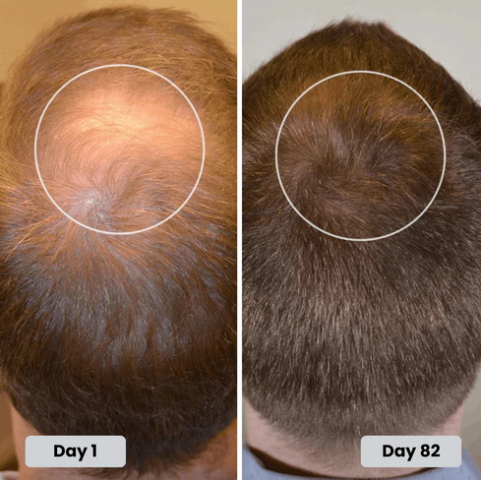 Red Light Therapy Cap for Hair Regrowth Treatment