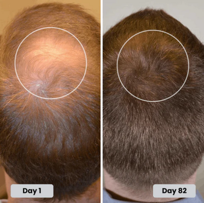 Red Light Therapy Cap for Hair Regrowth Treatment