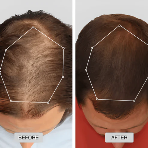 Red Light Therapy Cap for Hair Regrowth Treatment