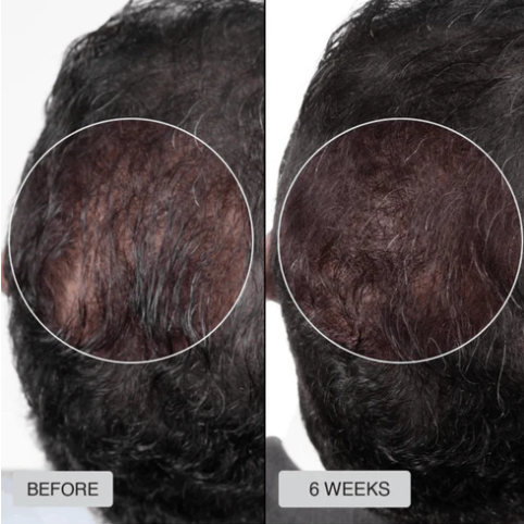 Red Light Therapy Cap for Hair Regrowth Treatment